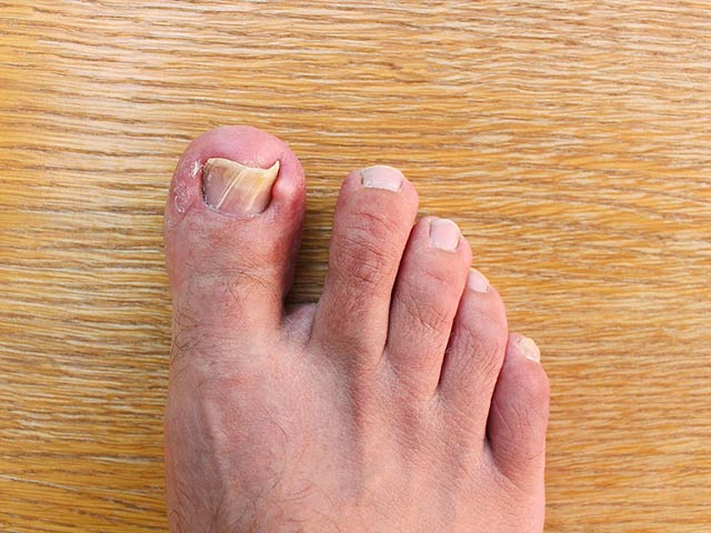 Laser Fungal Nail Treatment & Therapy