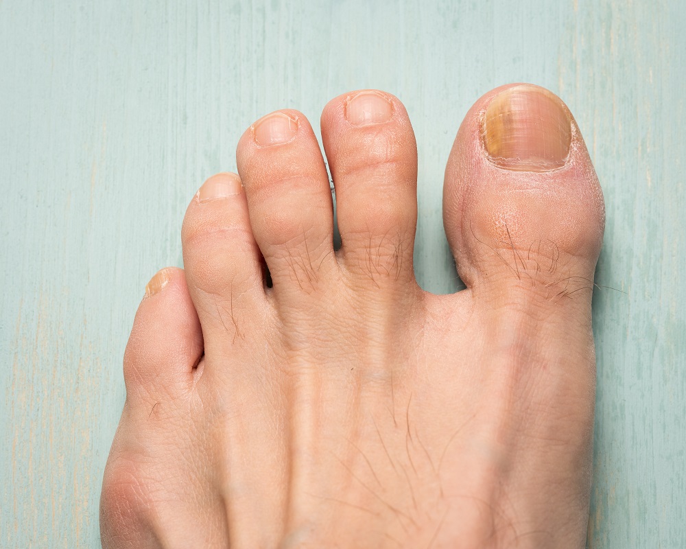 Foot Problems - Foot Care Centre Clonmel
